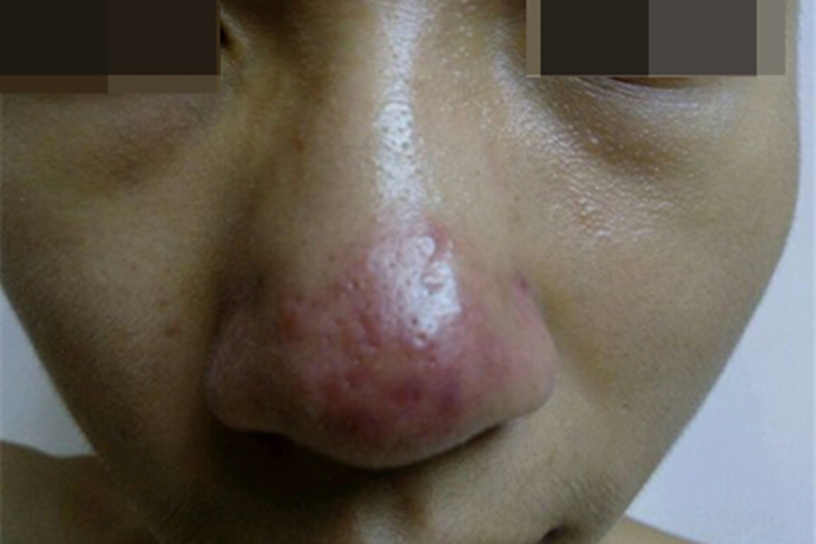 丘疹脓疱型酒糟鼻丘疹图 丘疹脓疱型酒糟鼻丘疹图