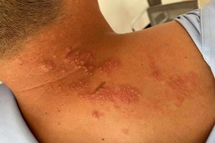 带状疱疹颈部水疱图