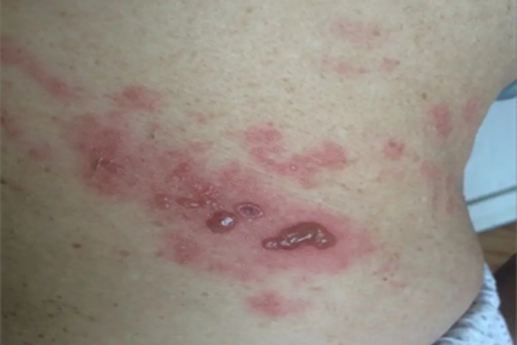 深脓疱疮腹部水疱图 深脓疱疮腹部水疱图