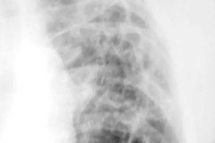 慢性纤维空洞性肺结核X光表现图