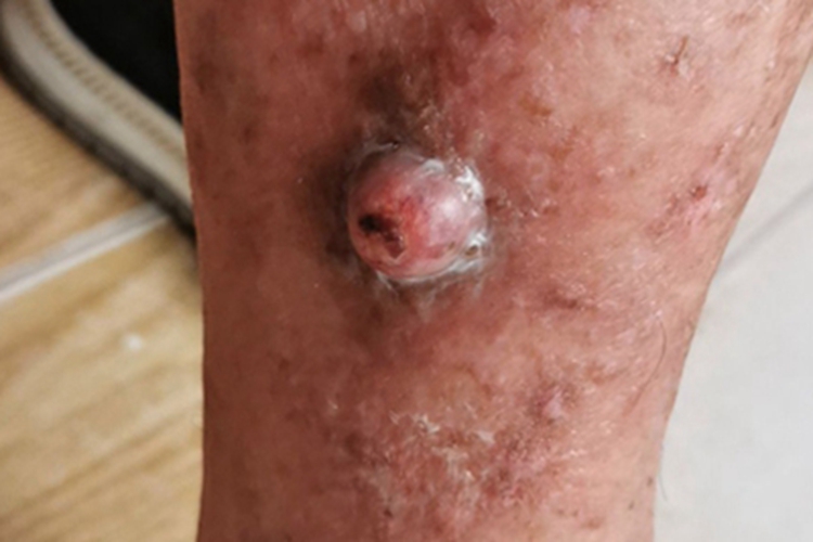 结节型基底细胞瘤小腿肿块图