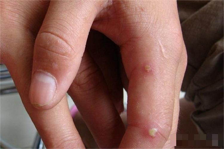 皮肤非典型分枝杆菌病手指脓包图