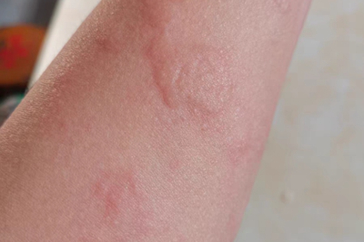 接触性荨麻疹红斑图