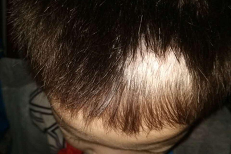 斑驳病头皮毛发变白图