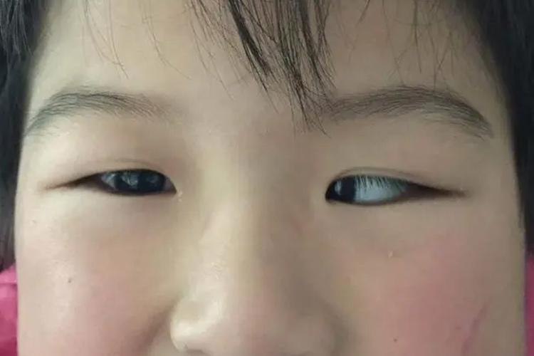 眼睛内斜视图
