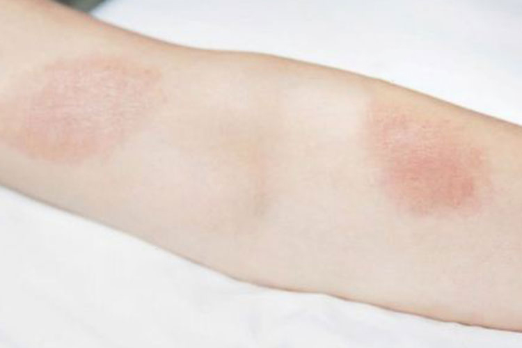 红色圆形斑片图