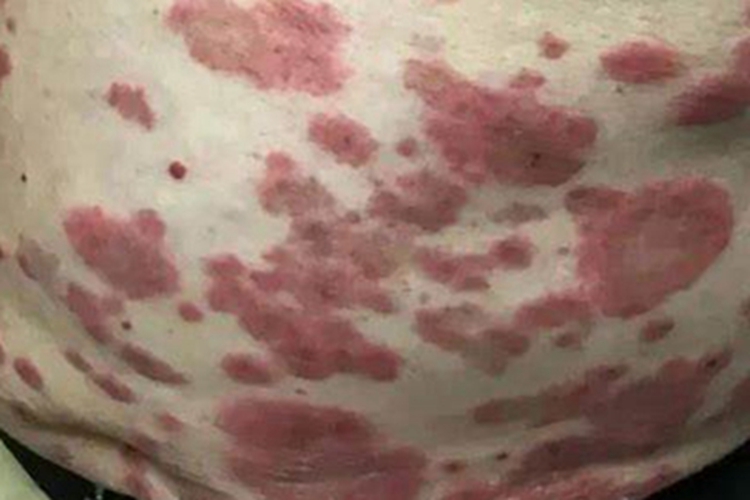 中毒性表皮坏死松解症腹部症状图