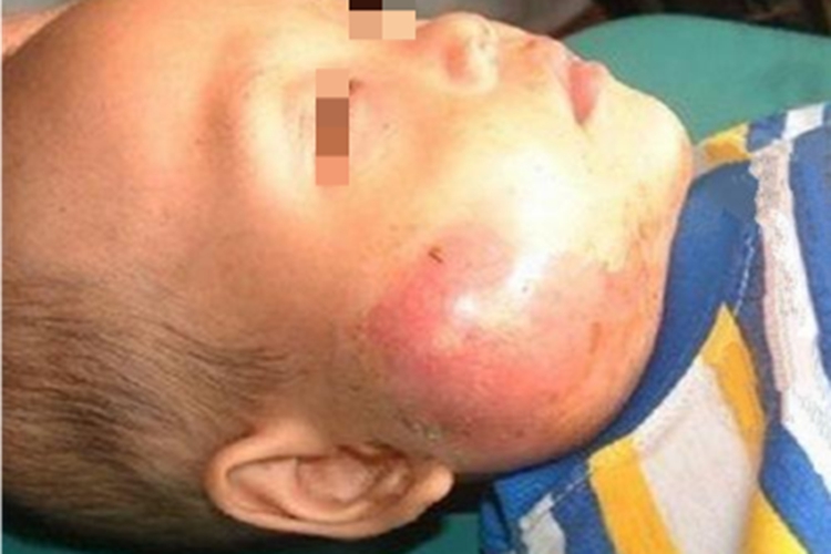 急性化脓性腮腺炎面部发红图