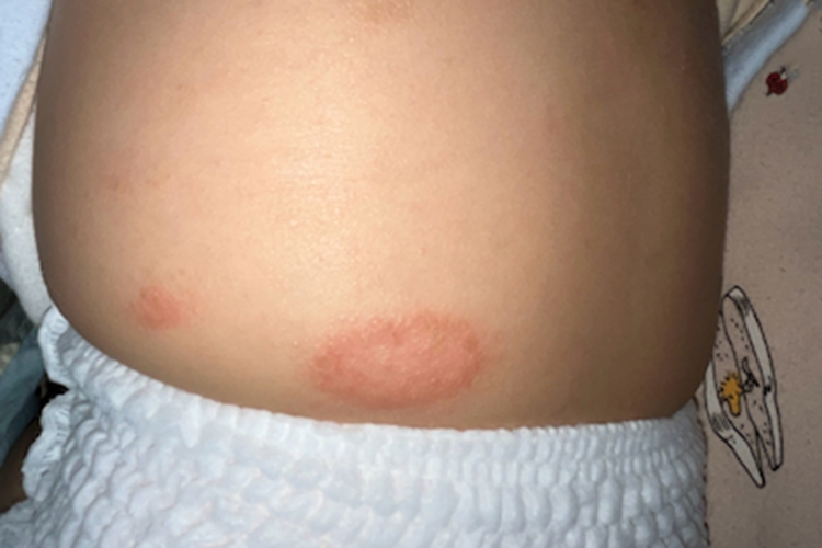 钱币状湿疹红斑图 钱币状湿疹红斑图