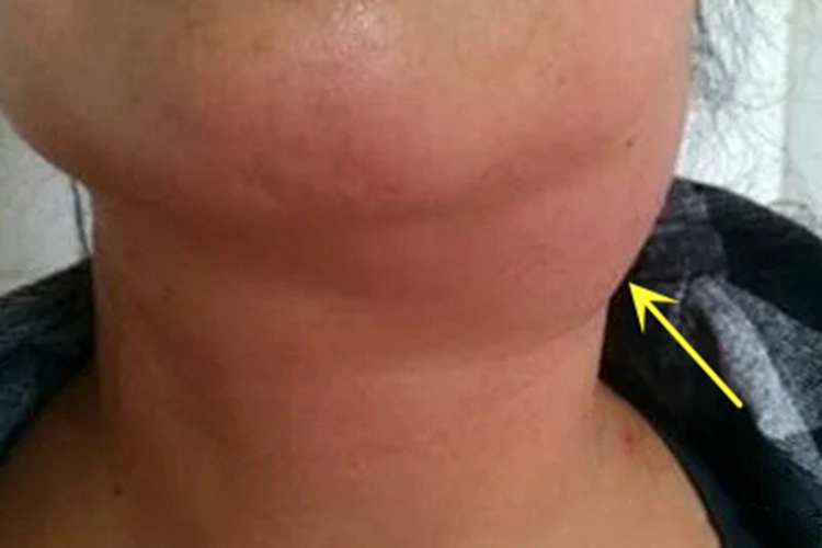 急性网状淋巴管炎大包图 急性网状淋巴管炎大包图