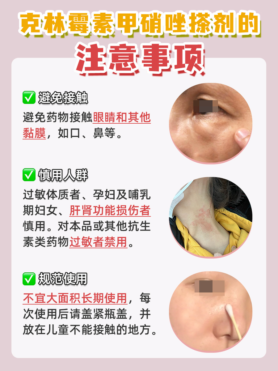 轻松get√ 克林霉素甲硝唑搽剂的使用技巧！