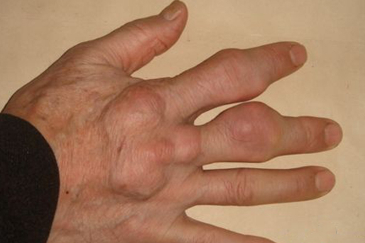 痛风性关节炎手指关节凸起图