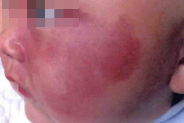 新生儿鲜红斑痣图