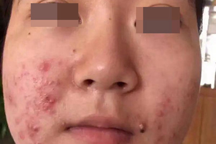 痤疮面部长丘疹和脓疱图