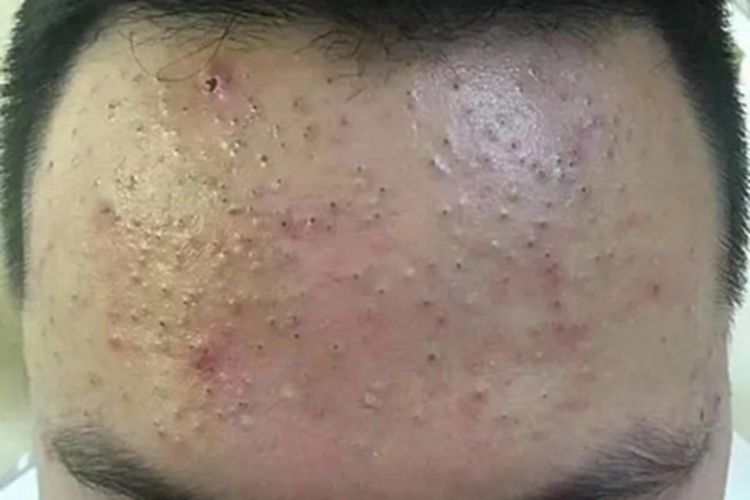 黑头粉刺痣疙瘩图