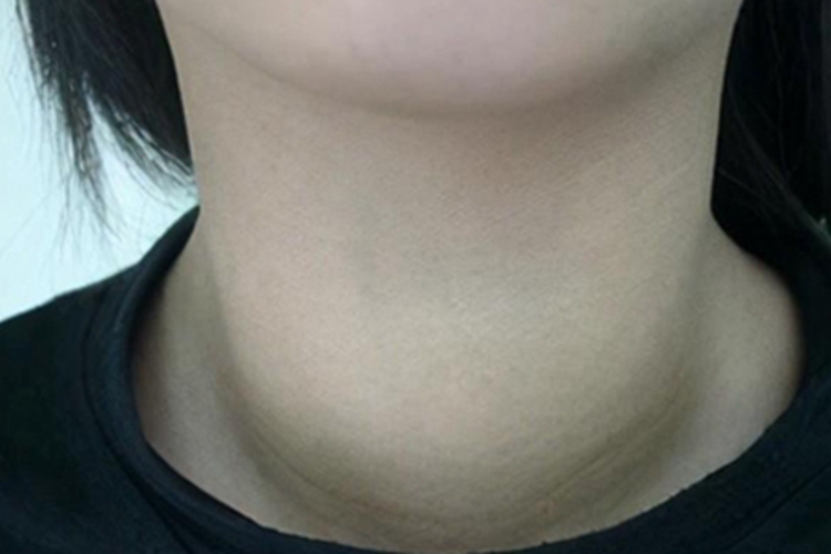 甲状腺亢进症脖子肿大图 甲状腺亢进症脖子肿大图