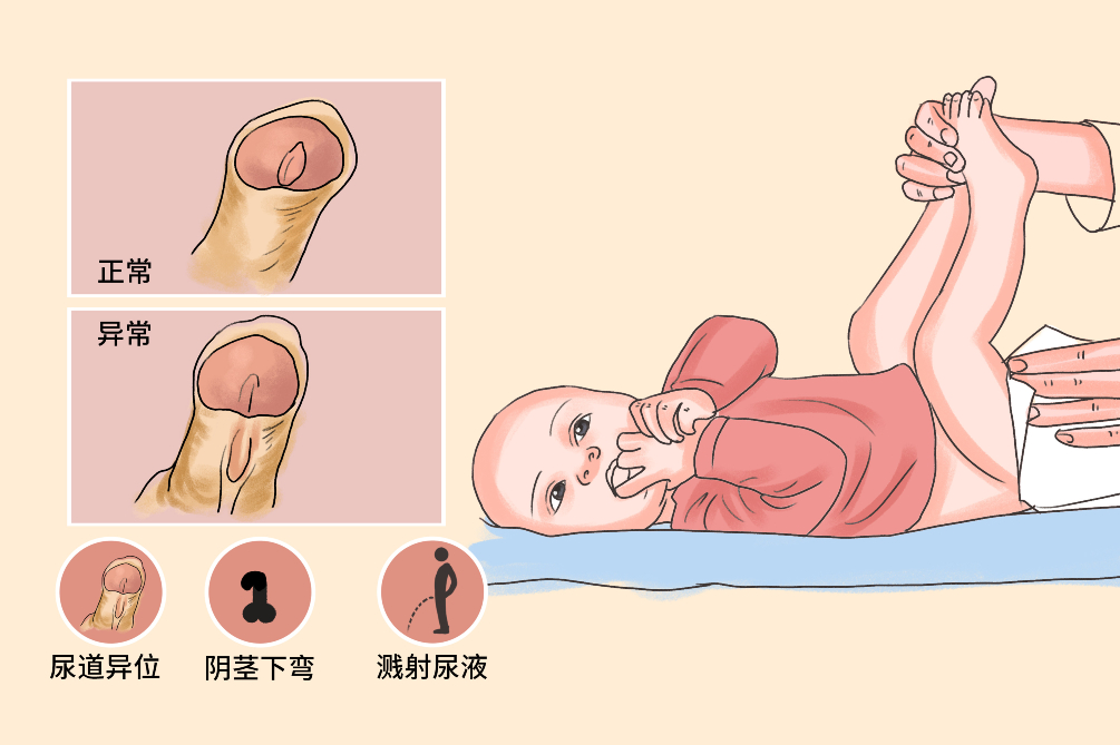 尿道下裂分型的图片图片