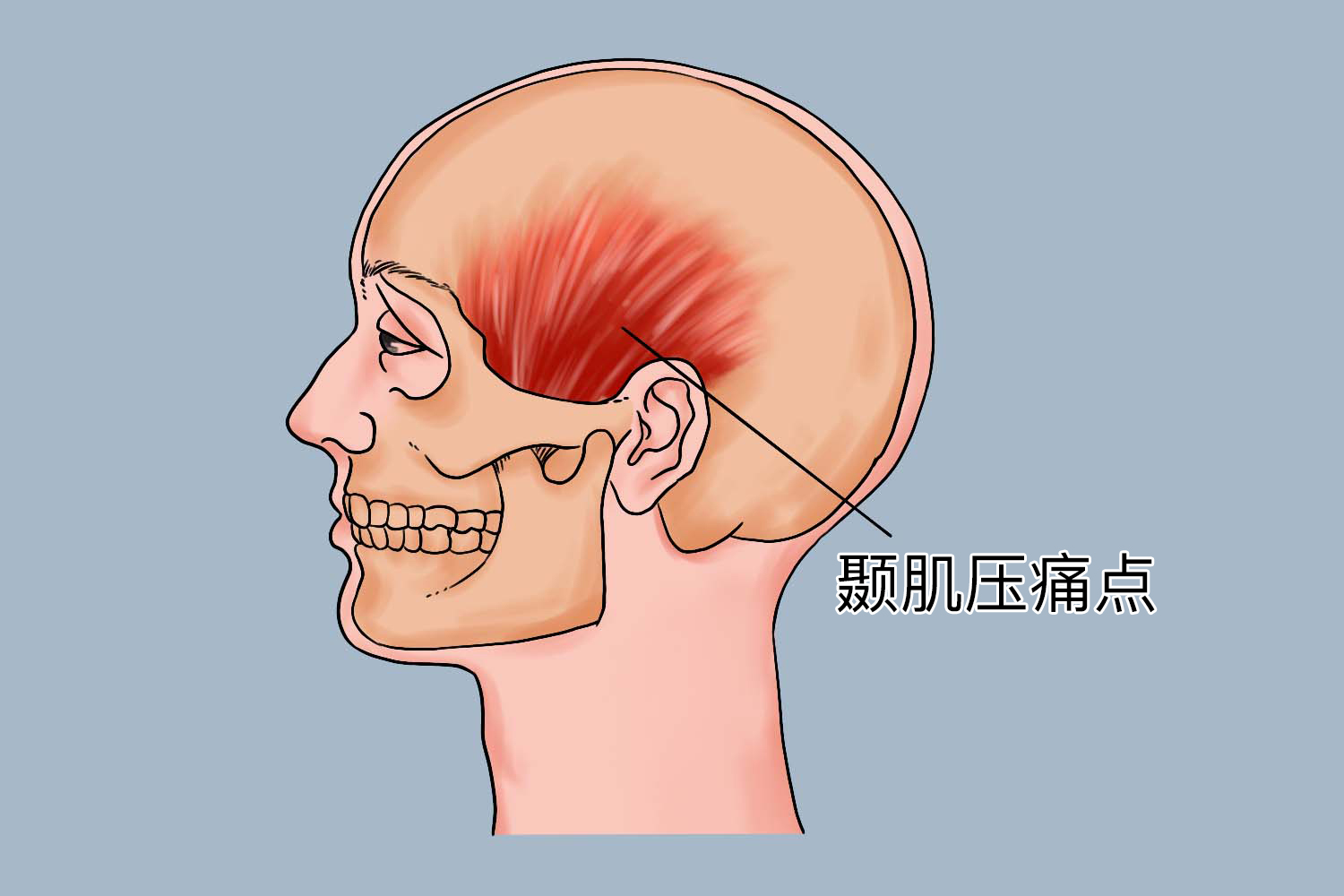 颞肌压痛点图