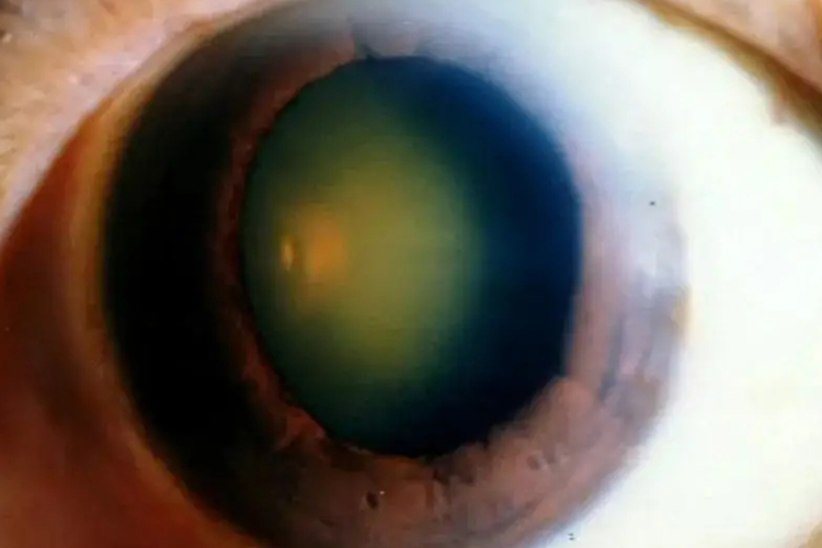 核性白内障眼球黄褐色图