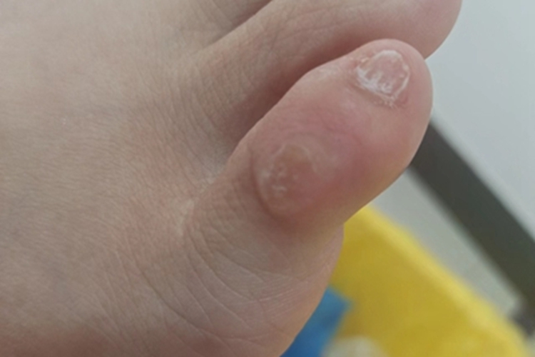 硬鸡眼脚趾硬疙瘩图 硬鸡眼脚趾硬疙瘩图