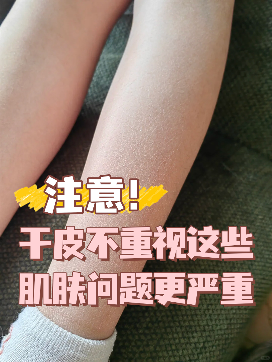 注意!干皮不重视这些,肌肤问题更严重