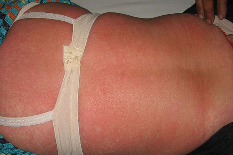 猩红热型药疹图