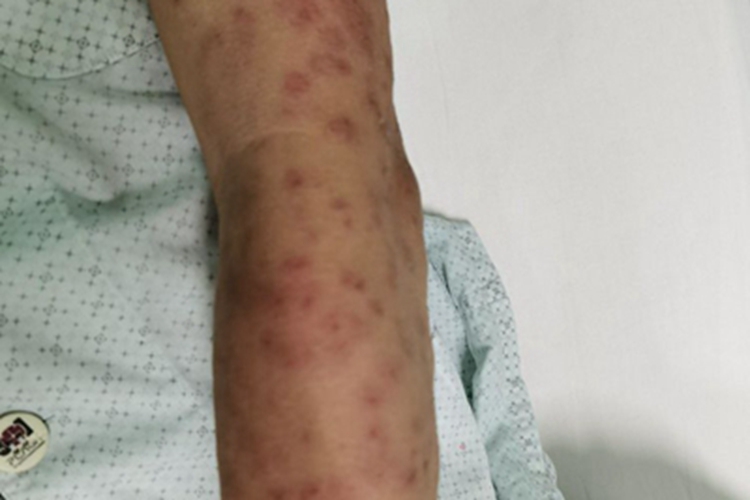 红斑狼疮胳膊丘疹图 红斑狼疮胳膊丘疹图