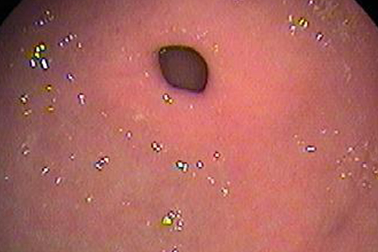 正常胃窦图 正常胃窦图