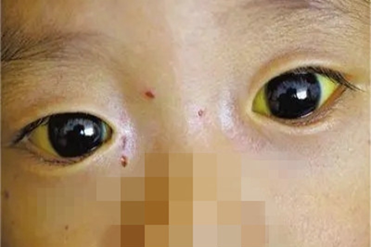先天性非溶血性黄疸眼球发黄图