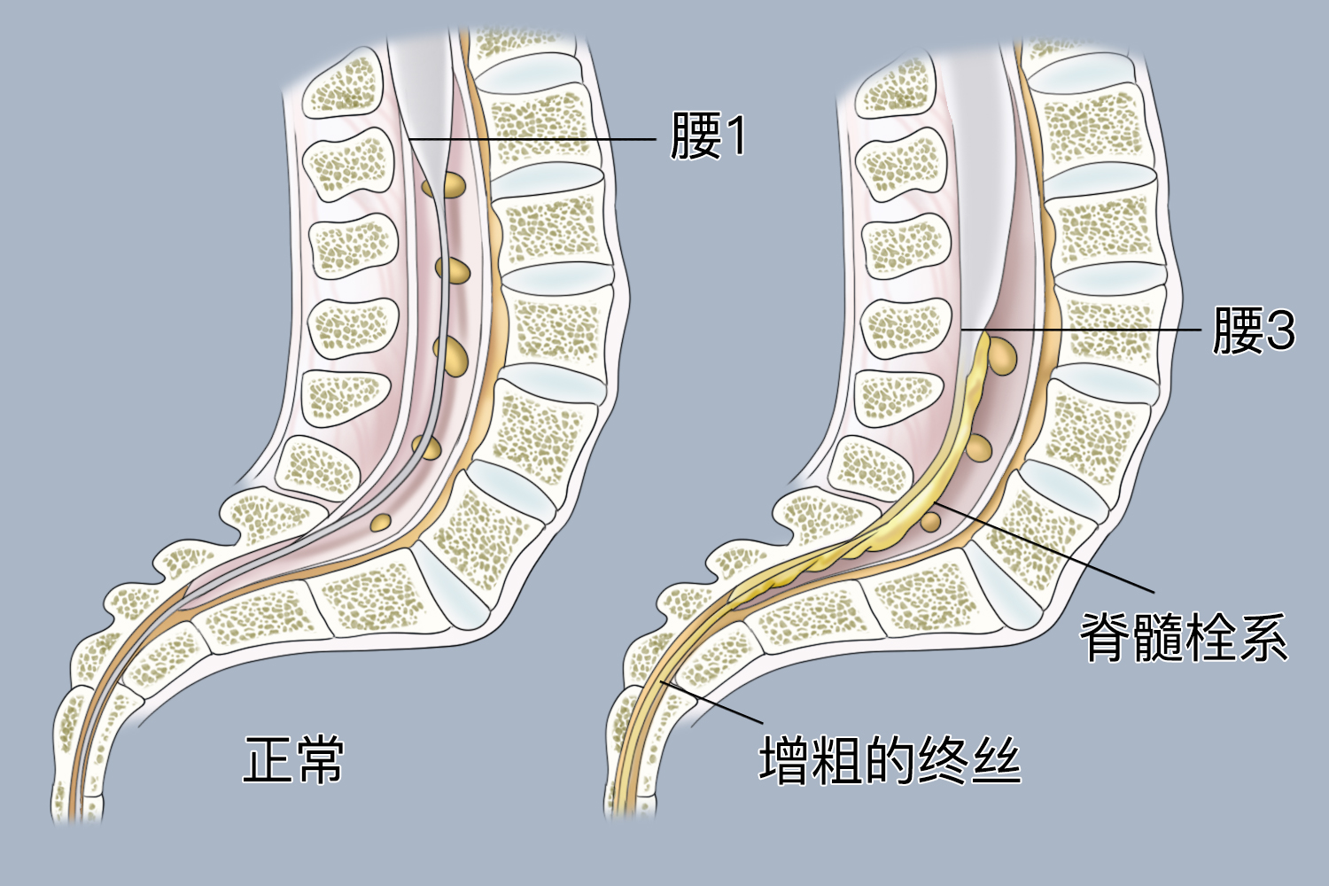 脊髓栓系对比图