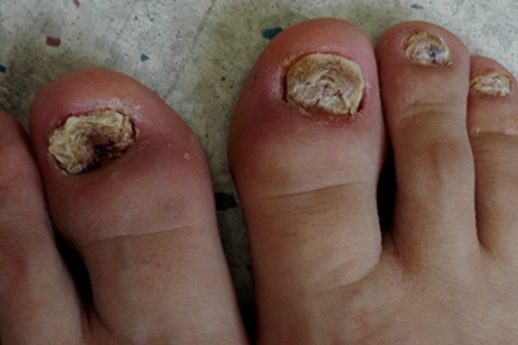银屑病甲脚趾甲症状图 银屑病甲脚趾甲症状图