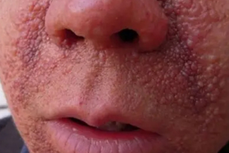 皮脂腺瘤面部小疙瘩图