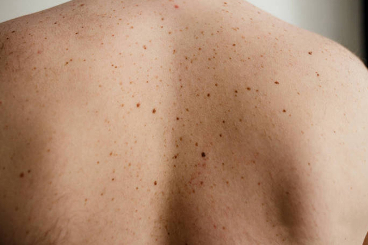 发育不良痣综合征背部黑斑图 发育不良痣综合征背部黑斑图