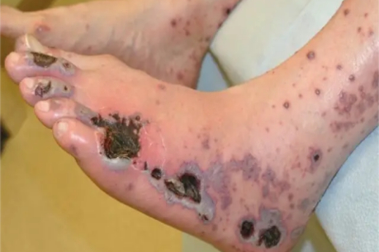 儿童结节性多动脉炎脚部黑痂图