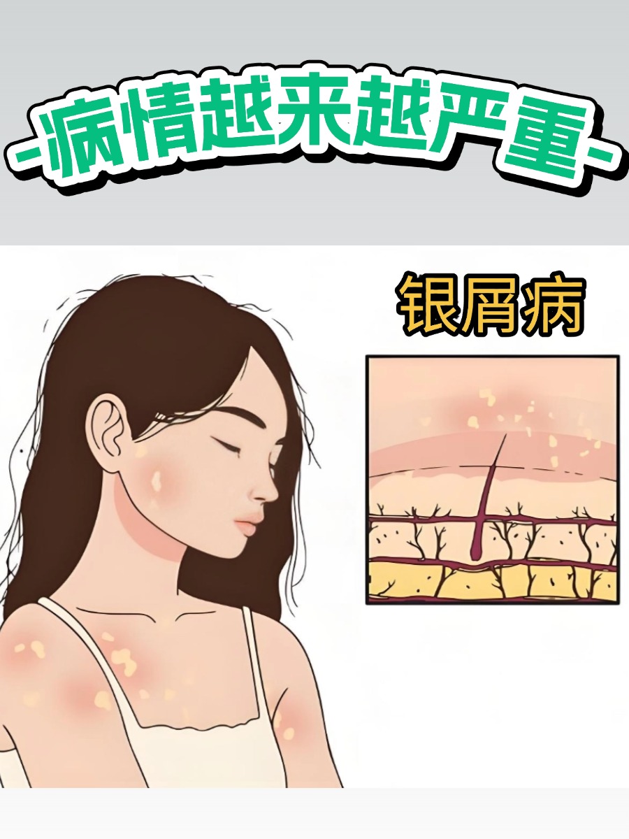 银屑病复发一次比一次严重吗？真相扎心了！
