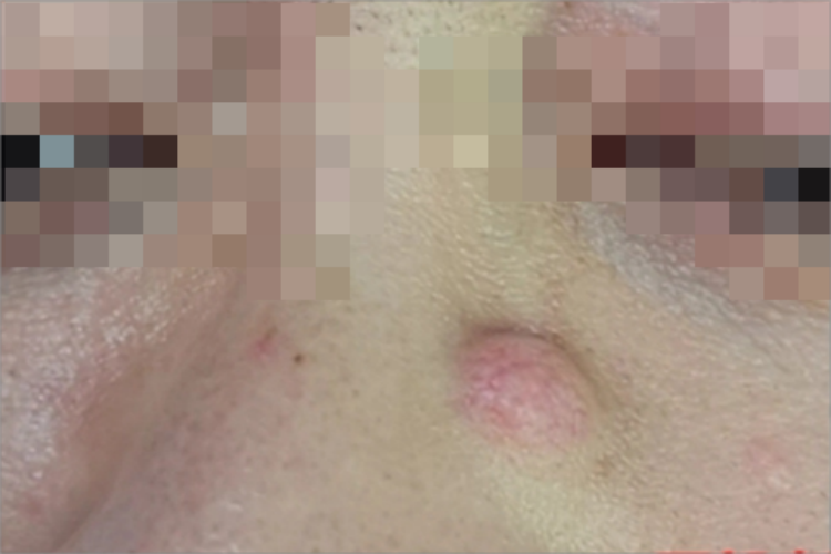 皮脂腺囊肿鼻部包块图 皮脂腺囊肿鼻部包块图