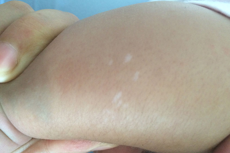 无色素痣大腿内侧白斑图