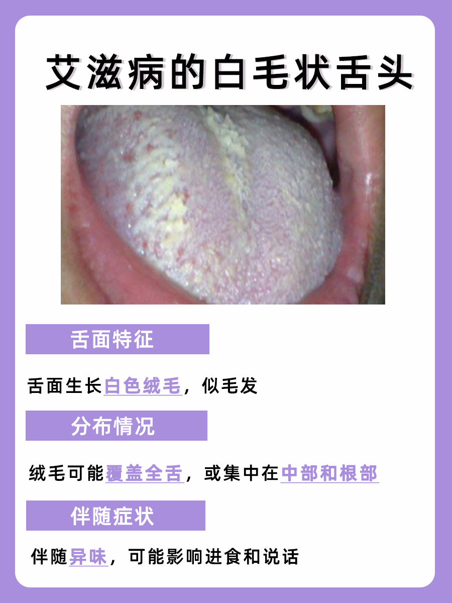艾滋病征兆：舌头上出现的白毛状变化