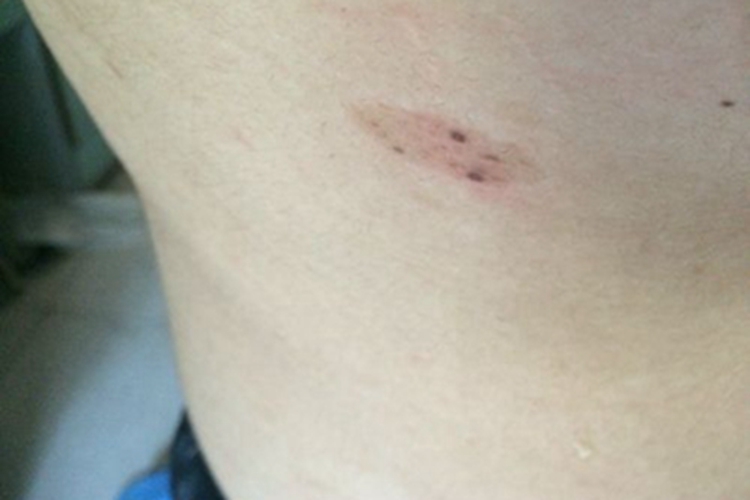 色素性紫癜性皮疹肋部紫斑图 色素性紫癜性皮疹肋部紫斑图