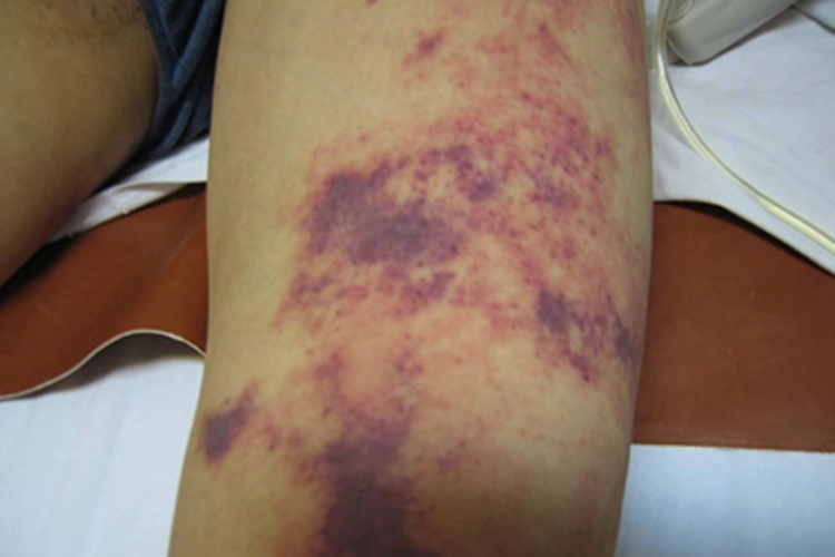 老年性紫癜腿部症状图