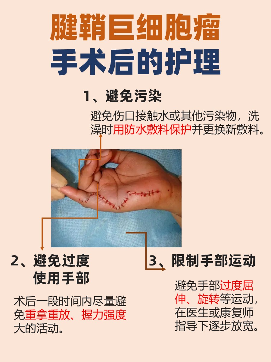 腱鞘巨细胞瘤手术费，你的钱包准备好了吗？