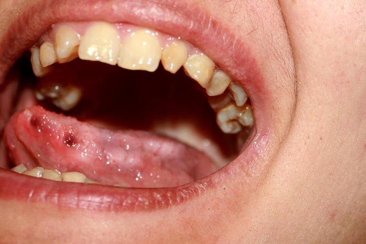 轻型阿弗他溃疡舌头红点图