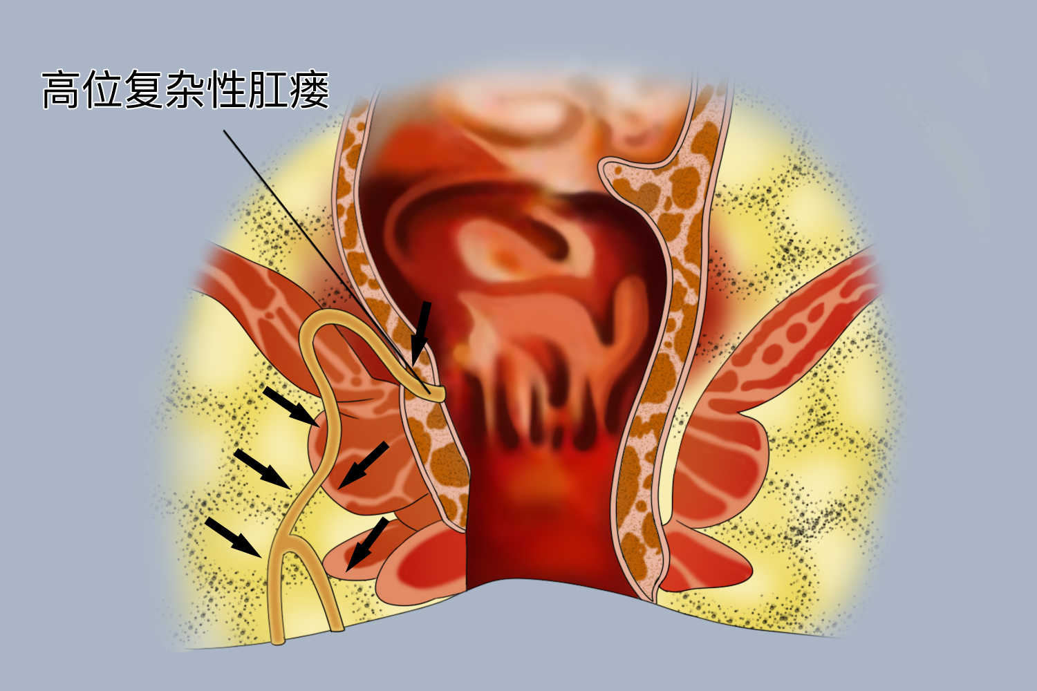 高位复杂性肛瘘图 高位复杂性肛瘘图
