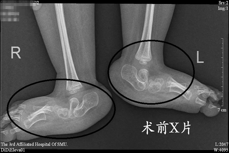 宝宝垂直距骨图