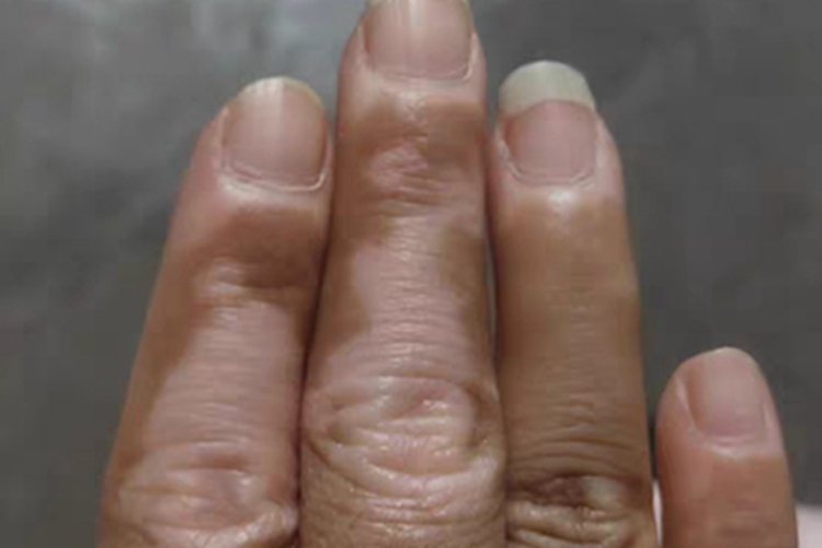 稳定期节段型白癜风手指白斑图