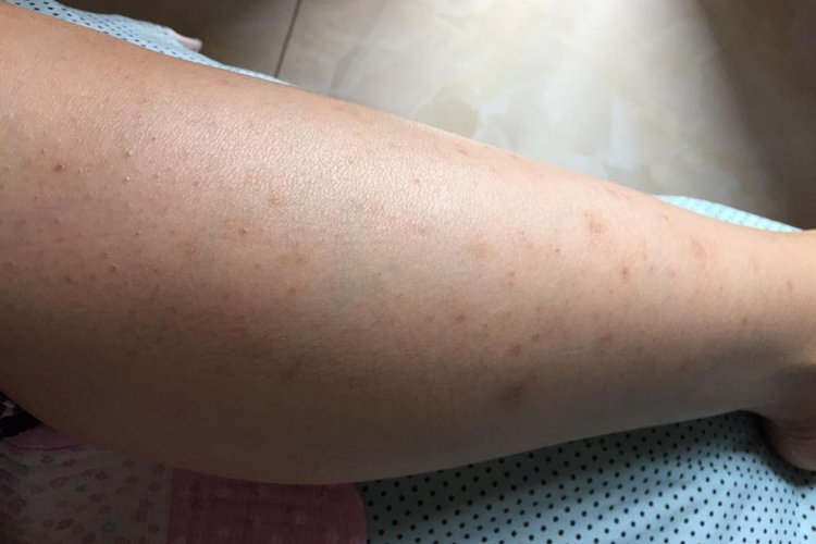 腿上炎症后色素沉着图