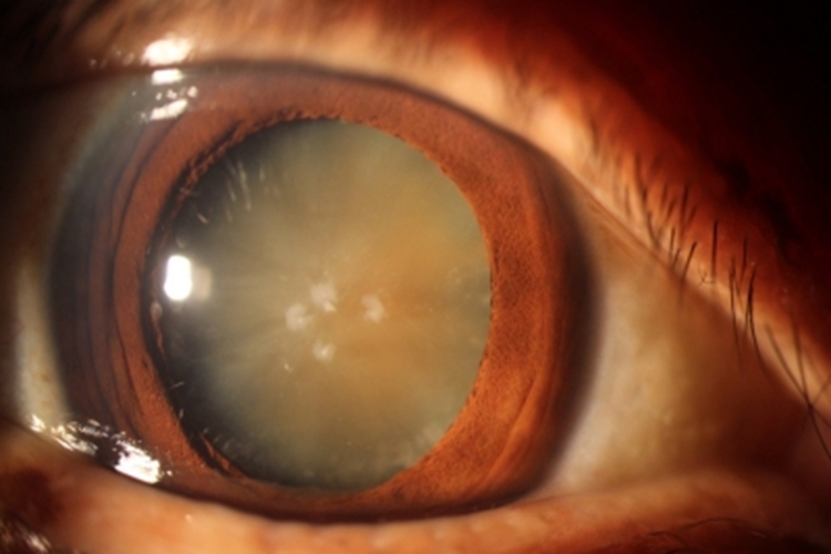 年龄相关性白内障眼球发黄图