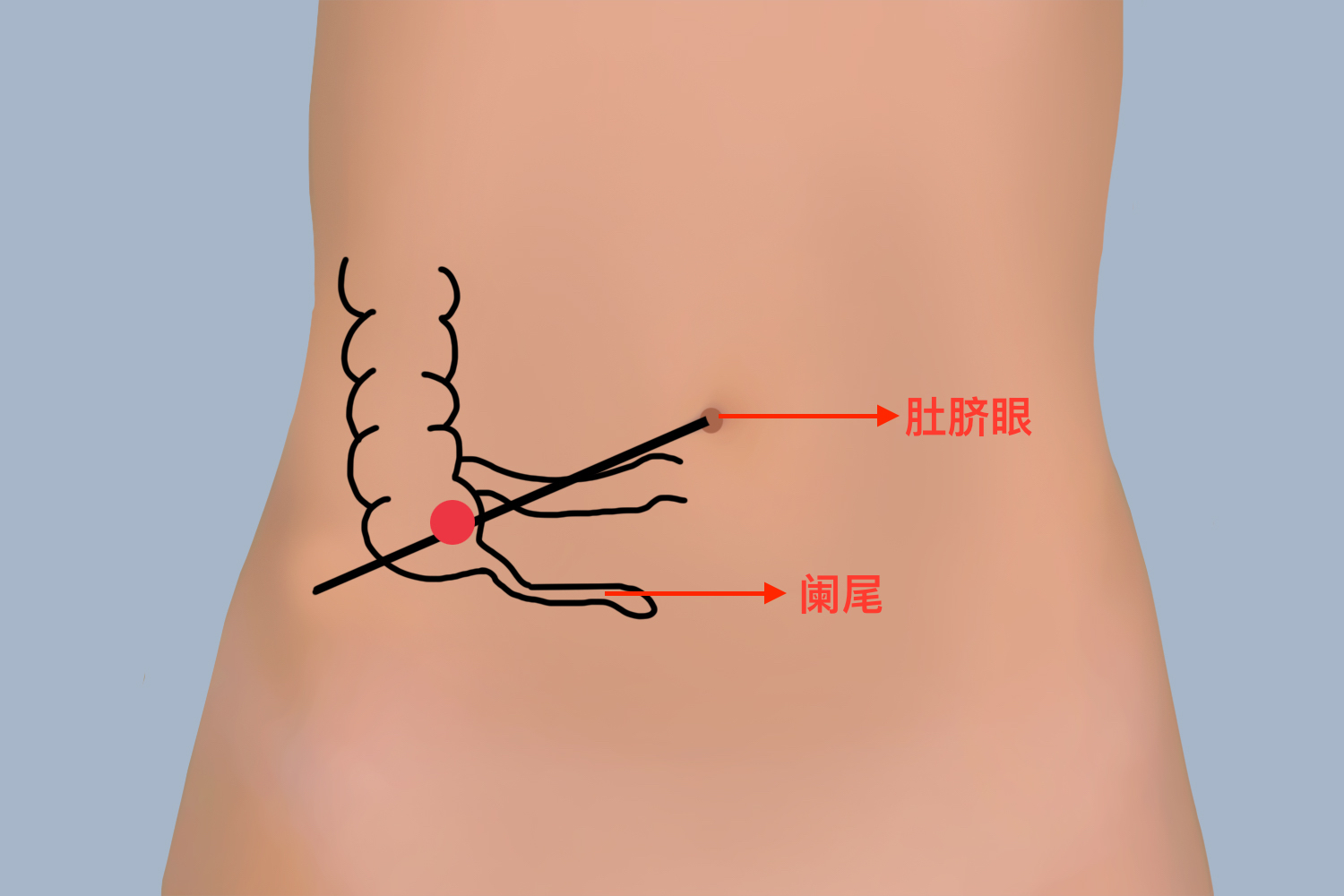 阑尾和肚脐眼位置图 阑尾和肚脐眼位置图