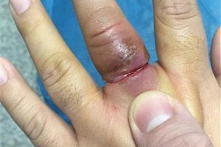 手部湿疹中指有红肿渗出图