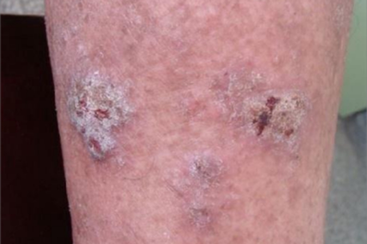 砷角化病小腿脱屑图